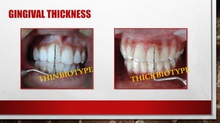 GINGIVAL THICKNESS
 