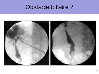 12
Obstacle biliaire ?
 