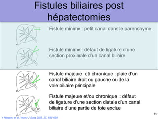 14
Fistules biliaires post
hépatectomies
Y Nagano et al. World J Surg 2003, 27, 695-698
Fistule minime : petit canal dans le parenchyme
Fistule minime : défaut de ligature d’une
section proximale d’un canal biliaire
Fistule majeure et/ chronique : plaie d’un
canal biliaire droit ou gauche ou de la
voie biliaire principale
Fistule majeure et/ou chronique : défaut
de ligature d’une section distale d’un canal
biliaire d’une partie de foie exclue
 