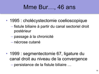 16
Mme Bur…, 46 ans
• 1995 : cholécystectomie coelioscopique
– fistule biliaire à partir du canal sectoriel droit
postérieur
– passage à la chronicité
– nécrose cutané
• 1999 : segmentectomie 67, ligature du
canal droit au niveau de la convergence
– persistance de la fistule biliaire …
 