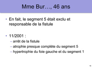 18
Mme Bur…, 46 ans
• En fait, le segment 5 était exclu et
responsable de la fistule
• 11/2001 :
– arrêt de la fistule
– atrophie presque complète du segment 5
– hypertrophie du foie gauche et du segment 1
 