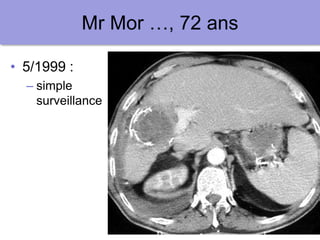 20
Mr Mor …, 72 ans
• 5/1999 :
– simple
surveillance
 
