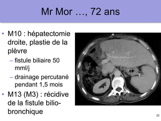 22
Mr Mor …, 72 ans
• M10 : hépatectomie
droite, plastie de la
plèvre
– fistule biliaire 50
mml/j
– drainage percutané
pendant 1,5 mois
• M13 (M3) : récidive
de la fistule bilio-
bronchique
 