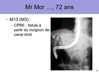 23
Mr Mor …, 72 ans
• M13 (M3) :
– CPRE : fistule à
partir du moignon de
canal droit
 