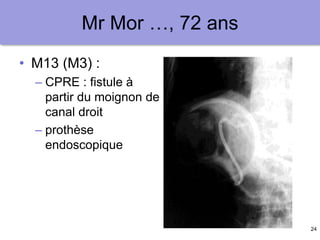 24
Mr Mor …, 72 ans
• M13 (M3) :
– CPRE : fistule à
partir du moignon de
canal droit
– prothèse
endoscopique
 