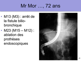 25
Mr Mor …, 72 ans
• M13 (M3) : arrêt de
la fistule bilio-
bronchique
• M23 (M15 – M12) :
ablation des
prothèses
endoscopiques
 