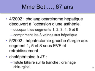 30
Mme Bet …, 67 ans
• 4/2002 : cholangiocarcinome hépatique
découvert à l’occasion d’une asthénie
– occupant les segments 1, 2, 3, 4, 5 et 8
– comprimant les 3 veines sus hépatique
• 5/2002 : hépatectomie gauche élargie aux
segment 1, 5 et 8 sous EVF et
refroidissement
• cholépéritoine à J7 :
– fistule biliaire sur la tranche : drainage
chirurgical
 