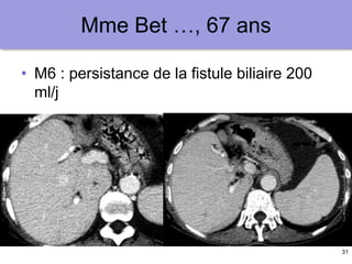 31
Mme Bet …, 67 ans
• M6 : persistance de la fistule biliaire 200
ml/j
 