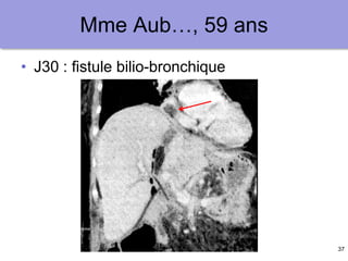 37
Mme Aub…, 59 ans
• J30 : fistule bilio-bronchique
 