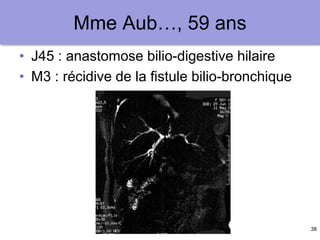 38
Mme Aub…, 59 ans
• J45 : anastomose bilio-digestive hilaire
• M3 : récidive de la fistule bilio-bronchique
 