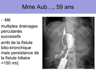39
Mme Aub…, 59 ans
• M6
multiples drainages
percutanés
successifs
arrêt de la fistule
bilio-bronchique
mais persistance de
la fistule biliaire
>150 ml/j
 
