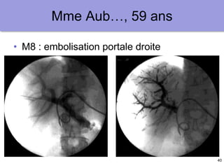 40
Mme Aub…, 59 ans
• M8 : embolisation portale droite
 