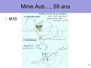 41
Mme Aub…, 59 ans
• M10
 