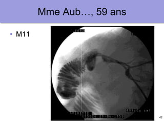 42
Mme Aub…, 59 ans
• M11
 