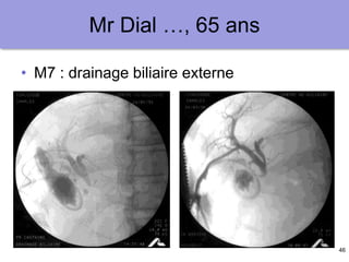 46
Mr Dial …, 65 ans
• M7 : drainage biliaire externe
 
