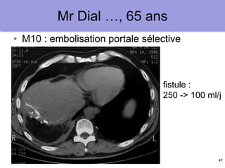 47
Mr Dial …, 65 ans
• M10 : embolisation portale sélective
fistule :
250 -> 100 ml/j
 