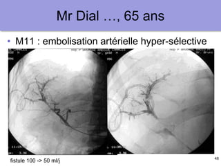 48
Mr Dial …, 65 ans
• M11 : embolisation artérielle hyper-sélective
fistule 100 -> 50 ml/j
 