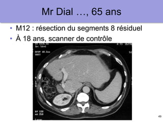 49
Mr Dial …, 65 ans
• M12 : résection du segments 8 résiduel
• À 18 ans, scanner de contrôle
 