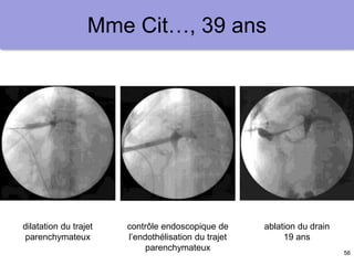 56
Mme Cit…, 39 ans
dilatation du trajet
parenchymateux
contrôle endoscopique de
l’endothélisation du trajet
parenchymateux
ablation du drain
19 ans
 