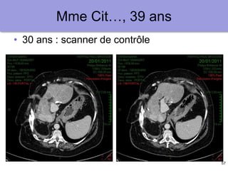 57
Mme Cit…, 39 ans
• 30 ans : scanner de contrôle
 