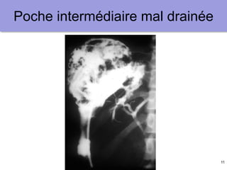 11
Poche intermédiaire mal drainée
 