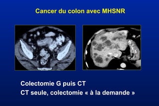 Cancer du colon avec MHSNR
Colectomie G puis CT
CT seule, colectomie « à la demande »
 
