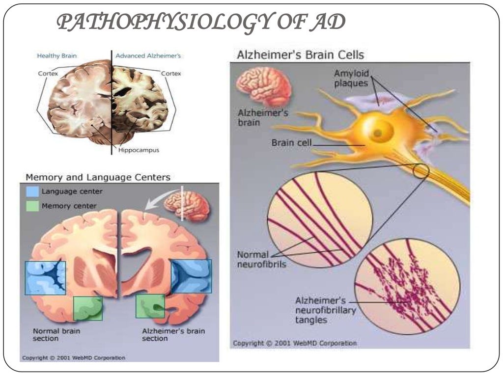 Oxidative stress and Alzheimer's disease