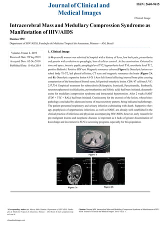 JournalofClinical and
Medical Images
ISSN: 2640-9615
Clinical Image
Intracerebral Mass and Medullary Compression Syndrome as
Manifestation of HIV/AIDS
Damian MM*
Department of HIV/AIDS, Fundação de Medicina Tropical do Amazonas, Manaus – AM, Brazil
1. Clinical Image
A 44-year-old woman was admitted to hospital with a history of fever, low back pain, paraesthesia
and paresis with evolution to paraplegia, loss of esficter control. At the examination: Oriented in
time and space, isocoric pupils, paraplegia level T12, hypoesthesia level T10, anesthesia level T12,
positive Babinski. Positive HIV test. Magnetic resonance column (Figure 1): Osteolytic lesion ver-
tebral body T1-T2, left pleural effusion; CT scan and magnetic resonance the brain (Figure 2A
and B): Osteolytic expansive lesion 4.9 X 1.4cm left frontal affecting internal bone plate causing
compression of the homolateral frontal turns, left parietal osteolytic lesion. CD4: 97 cell/mm3; VC:
257,734. Empirical treatment for tuberculosis (Rifampicin, Isoniazid, Pyrazinamide, Etmbutol),
neurotoxoplasmosis (sulfadiazine, pyrimethamine and folinic acid) had been initiated;dexameth-
asone for medullary compression syndrome and intracranial hypertension. After 2 weeks HART
(TDF + 3TC + RAL) had been initiated. Craniectomy for the exeresis of the lesion, whose histo-
pathology concluded by adenocarcinoma of mucosecretory pattern, being indicated radiotherapy.
The patient presented respiratory and urinary infection culminating with death. Supportive ther-
apy, prophylaxis of opportunistic infections, as well as HART, are already well established in the
clinical practice of infectious and physician accompanying HIV/AIDS, however, early research for
pre-malignant lesions and neoplastic diseases is important as it lacks of greater dissemination of
knowledge and investment in SUS in screening programs especially for this population.
Figure: 1
Figure: 2a Figure: 2b
*Corresponding Author (s): Marcia Melo Damian, Department of HIV/AIDS, Funda-
ção de Medicina Tropical do Amazonas, Manaus – AM, Brazil, E-mail: jorgemarcia@
uol.com.br
Citation: Damian MM, Intracerebral Mass and Medullary Compression Syndrome as Manifestation of HIV/
AIDS. Journal of Clinical and Medical Images. 2019; V2(3): 1.
clinandmedimages.com
Volume 2 Issue 4- 2019
Received Date: 20 Sep 2019
Accepted Date: 05 Oct 2019
Published Date: 10 Oct 2019
 