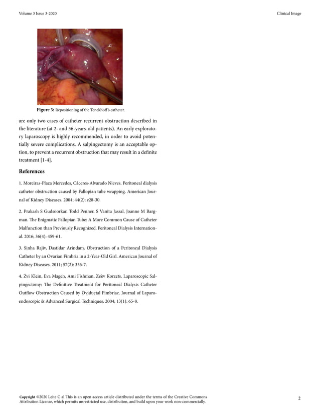 Tenckhoff’s Catheter Recurrent Obstruction by Fallopian Tube