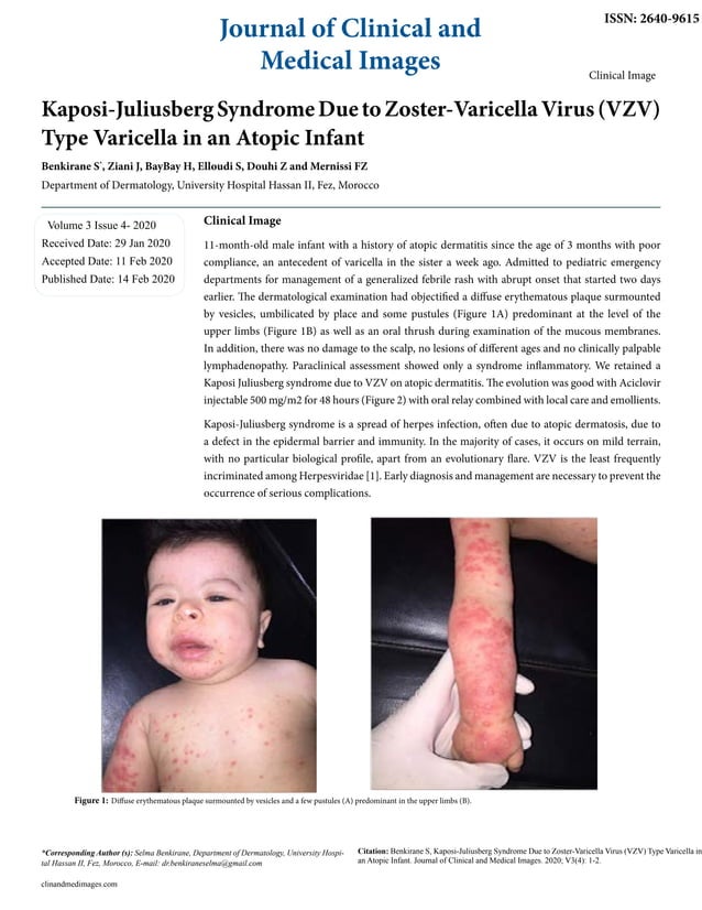 KaposiJuliusberg Syndrome Due to ZosterVaricella Virus (VZV) Type
