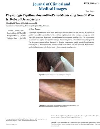 JournalofClinicaland
MedicalImages
ISSN: 2640-9615
Case Report
PhysiologicPapillomatosisofthePenis Mimicking GenitalWar-
ts: Role ofDermoscopy
ElboukhariK*
,RassoA,DouhiZ,MernissiFZ
Department of Dermatology, University Hospital of fez, Morocco
1. Case Report
Physiologic papillomatosis of the penis is a benign, non-infectious affection that may be confused to
genital warts and it is assimilated to the vestibular papillomatosis in the woman. A young man of 21
years old, came to our department with a history of non protected sexual activity. Our examination
found small and regular mini-papules sitting in the coronal groove, without deboarding it (Figure 1).
The dermoscopy supported our diagnosis by showing a transparent papilla with different insertion
bases (Figure 2). We explained this anatomic variety to the patient who was reassured. We indicated a
serological assessment only for the history of unprotected sexual activity.
Figure 1: Trasparent minipapules in the coronal groove of the penis
Figure2:Seenbydermoscopy,thecoronalgrooveshowedregularpapillomatosis,with
different bases of implantation, without axial vascularisation
*Corresponding Author (s): Khadija Elboukhari, Department of Dermatology, University
Hospital of fez, Morocco, E-mail: elboukharikhadija89@gmail.com
Citation: Elboukhari K. Physiologic Papillomatosis of the Penis Mimicking Genital Warts: Role of Der-
moscopy. Journal of Clinical and Medical Images. 2020; V3(6): 1-1.
Copyright ©2020 Elboukhari K al This is an open access article distributed under the terms of the Creative
clinandmedimages.com Commons Attribution License, which permits unrestricted use, distribution, and build upon your work
non-commercially.
Volume 3 Issue 6- 2020
Received Date: 24 Mar 2020
Accepted Date: 12 Apr2020
Published Date: 15 Apr2020
 