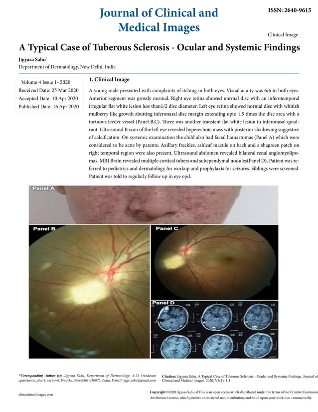 A Typical Case of Tuberous Sclerosis Ocular and Systemic Findings