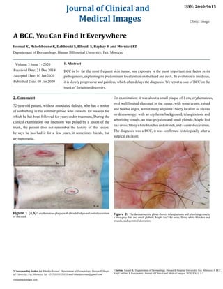 Journal of Clinical and
Medical Images
A BCC, YouCan Find It Everywhere
Issoual K*
, Achehboune K, Dahhouki S, Elloudi S, Baybay H and Mernissi FZ
Departement of Dermatology, Hassan II Hospital University, Fez, Morocco
ISSN: 2640-9615
Clinicl Image
Volume 3 Issue 1- 2020
Received Date: 21 Dec 2019
Accepted Date: 03 Jan 2020
Published Date: 08 Jan 2020
2. Comment
1. Abstract
BCC is by far the most frequent skin tumor, sun exposure is the most important risk factor in its
pathogenesis, explaining its predominant localization on the head and neck. Its evolution is insidious,
it is slowly progressive and painless, which often delays the diagnosis. We report a case of BCC on the
trunk of fortuitous discovery.
On examination: it was about a small plaque of 1 cm, erythematous,
72-year-old patient, without associated defects, who has a notion
of sunbathing in the summer period who consults for rosacea for
which he has been followed for years under treatment, During the
clinical examination our intension was pulled by a lesion of the
trunk, the patient does not remember the history of this lesion:
he says he has had it for a few years, it sometimes bleeds, but
asymptomatic.
Figure 1 (a,b): erythematousplaquewithabeadededgesandcentralulceration
of the trunk
oval well limited ulcerated in the center, with some crusts, raised
and beaded edges, within many angioma cheery localize au niveau
on dermoscopy: with an erythema background, telangiectasia and
arborizing vessels, an blue-gray dots and small globule, Maple leaf
likeareas,Shinywhiteblotchesand strands,and acentralulceration.
The diagnosis was a BCC, it was confirmed histologically after a
surgical excision.
Figure 2: The dermatoscopic photo shows: telangiectasia and arborizing vessels,
a blue-gray dots and small globule, Maple leaf like areas, Shiny white blotches and
strands, and a centralulceration.
*Corresponding Author (s): Khadija Issoual, Departement of Dermatology, Hassan II Hospi-
tal University, Fez, Morocco, Tel: 0212655085268, E-mail:khadijaissoual@gmail.com
clinandmedimages.com
Citation: Issoual K, Departement of Dermatology, Hassan II Hospital University, Fez, Morocco. A BCC,
You Can Find It Everywhere. Journal of Clinical and Medical Images. 2020; V3(1): 1-2.
 