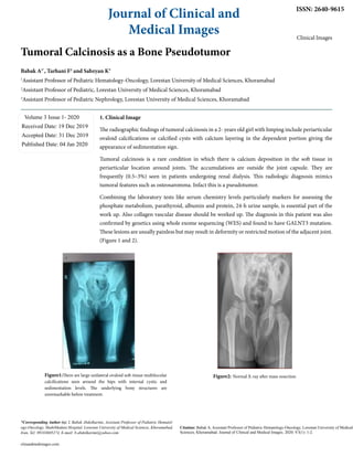 Journal of Clinical and
Medical Images
ISSN: 2640-9615
Clinical Images
Tumoral Calcinosis as a Bone Pseudotumor
Babak A1*
, Tarhani F2
and Sabzyan K3
1
Assistant Professor of Pediatric Hematology-Oncology, Lorestan University of Medical Sciences, Khoramabad
2
Assistant Professor of Pediatric, Lorestan University of Medical Sciences, Khoramabad
3
Assistant Professor of Pediatric Nephrology, Lorestan University of Medical Sciences, Khoramabad
Volume 3 Issue 1- 2020
Received Date: 19 Dec 2019
Accepted Date: 31 Dec 2019
Published Date: 04 Jan 2020
*Corresponding Author (s): : Babak Abdolkarimi, Assistant Professor of Pediatric Hematol-
ogy-Oncology, ShahiMadani Hospital, Lorestan University of Medical Sciences, Khoramabad,
Iran, Tel: 09183605274, E-mail: b.abdolkarimi@yahoo.com
clinandmedimages.com
Citation: Babak A, Assistant Professor of Pediatric Hematology-Oncology, Lorestan University of Medical
Sciences, Khoramabad. Journal of Clinical and Medical Images. 2020; V3(1): 1-2.
1. Clinical Image
The radiographic findings of tumoral calcinosis in a 2- years old girl with limping include periarticular
ovaloid calcifications or calcified cysts with calcium layering in the dependent portion giving the
appearance of sedimentation sign.
Tumoral calcinosis is a rare condition in which there is calcium deposition in the soft tissue in
periarticular location around joints. The accumulations are outside the joint capsule. They are
frequently (0.5–3%) seen in patients undergoing renal dialysis. This radiologic diagnosis mimics
tumoral features such as osteosaromma. Infact this is a pseudotumor.
Combining the laboratory tests like serum chemistry levels particularly markers for assessing the
phosphate metabolism, parathyroid, albumin and protein, 24-h urine sample, is essential part of the
work up. Also collagen vascular disease should be worked up. The diagnosis in this patient was also
confirmed by genetics using whole exome sequencing (WES) and found to have GALNT3 mutation.
These lesions are usually painless but may result in deformity or restricted motion of the adjacent joint.
(Figure 1 and 2).
Figure1:There are large unilateral ovaloid soft-tissue multilocular
calcifications seen around the hips with internal cystic and
sedimentation levels. The underlying bony structures are
unremarkable before treatment.
Figure2: Normal X-ray after mass resection
 