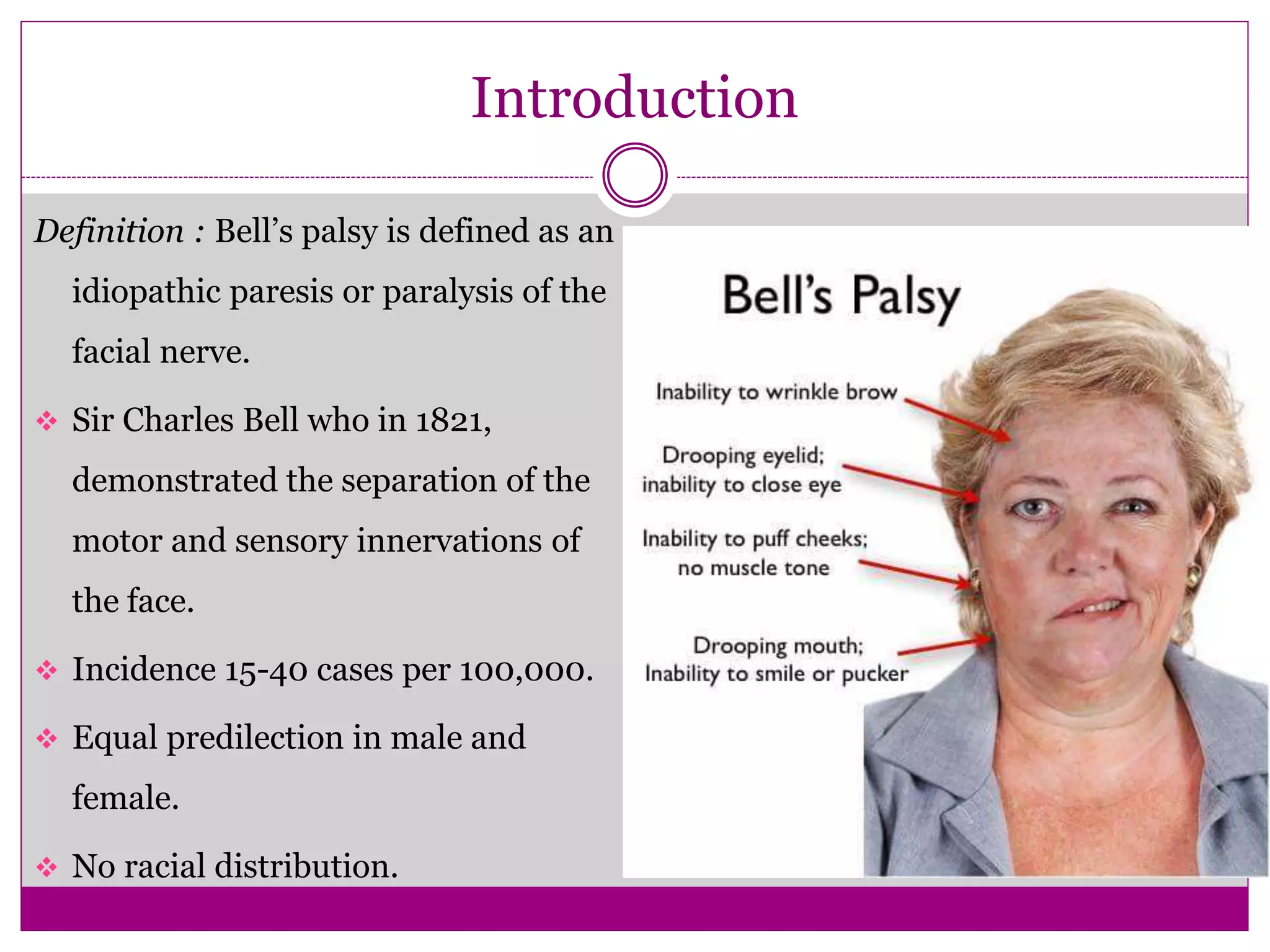 Predilection Def jc on bells palsy.pptx