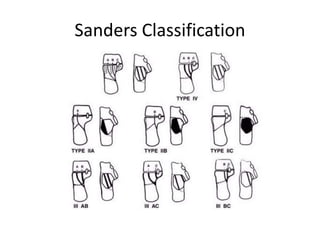 Sanders Classification Examples JC on CALCANEUM FRACTURE | PPTX