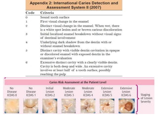 Caries Code R1 Jc on caries diagnostic tools | PPTX
