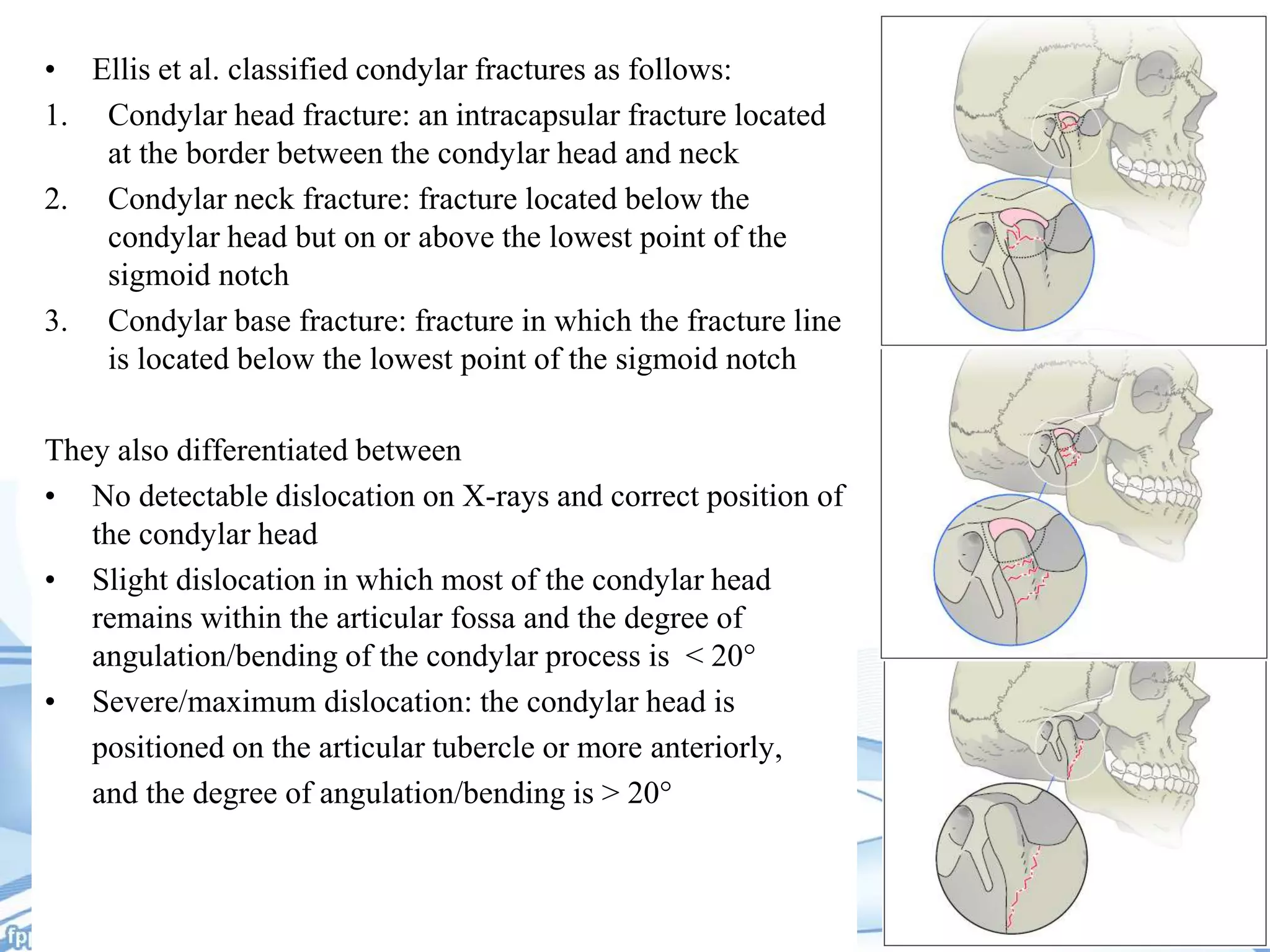 Condylar Rods Condylar Base