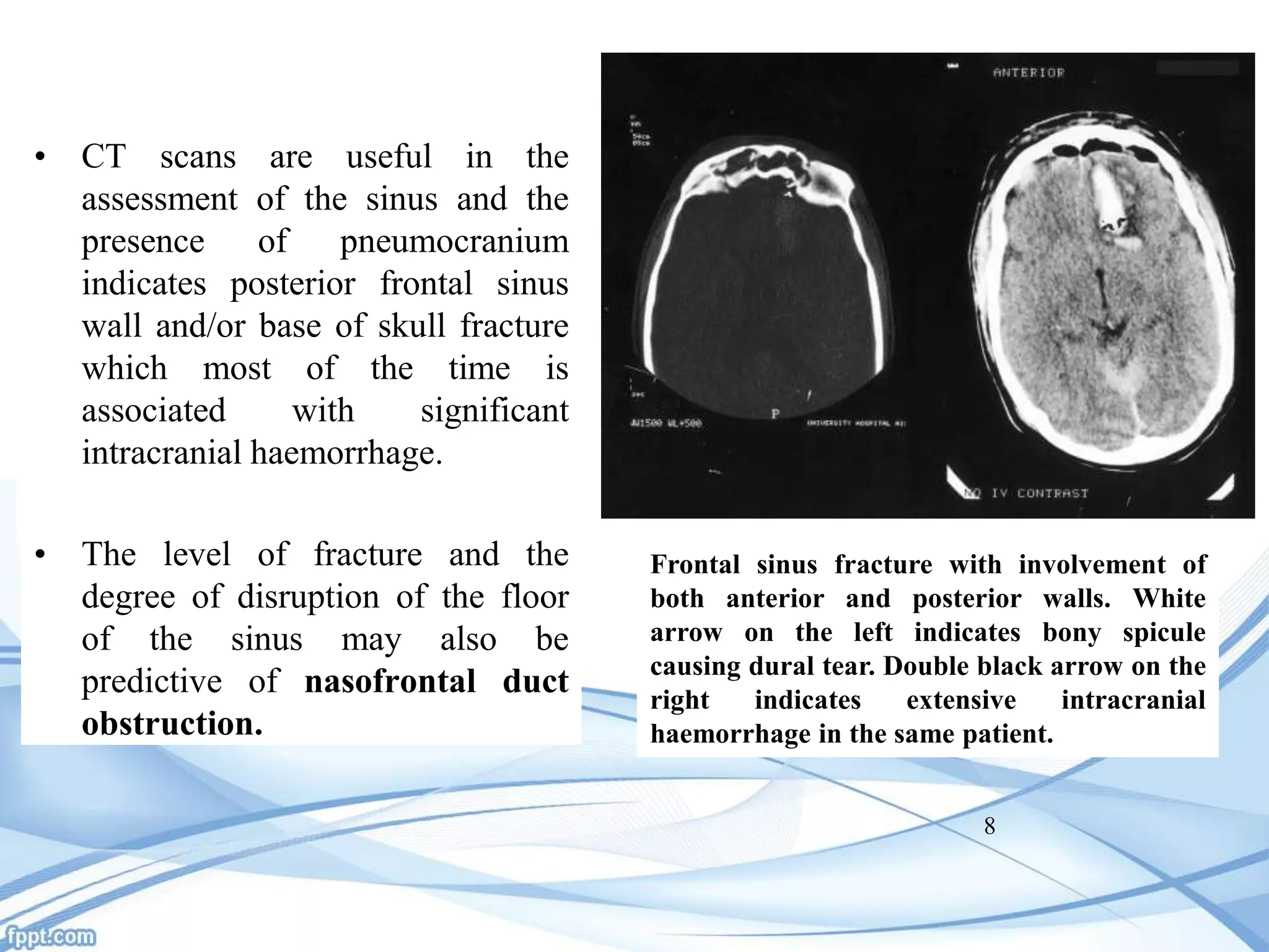 Pneumocranium Radiograph Jc on frontal fracture | PPTX