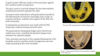 Journal club presentation on lingualised occlusion | PPTX