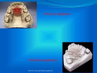 Distalisation Jet Pendulum appliance versus distal jet distalizing appliance. | PPTX
