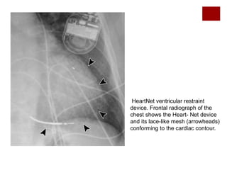Radiographic Review of Current Therapeutic and Monitoring Devices in ...