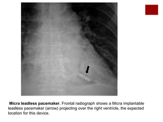 Leadless Pacemaker On Radiograph Radiographic Review of Current Therapeutic and Monitoring Devices in ...