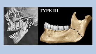 jc ramus fracture classification lghjhggjygj | PPTX