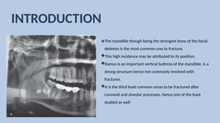 Strong Ramus jc ramus fracture classification lghjhggjygj | PPTX