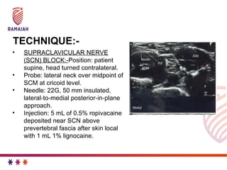 JC regional anaesthesia for clavicular fracture | PPTX