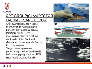 JC regional anaesthesia for clavicular fracture | PPTX
