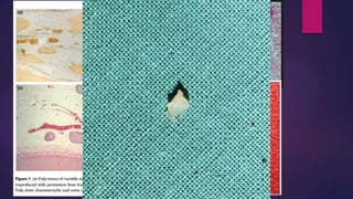 Embedded Pulp Stone Jc review pulp stone | PPTX