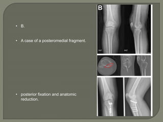 ortho journal club by Dr. Amit Motwani | PPTX