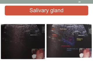 Salivary gland
25
 